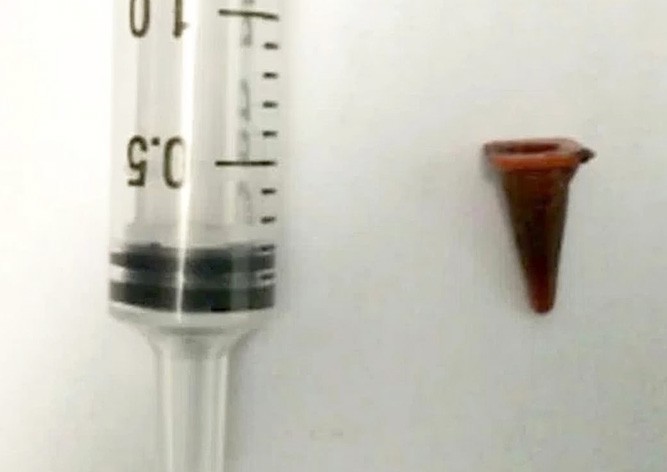 В лёгком пациента вместо рака нашли игрушку