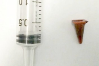 В лёгком пациента вместо рака нашли игрушку